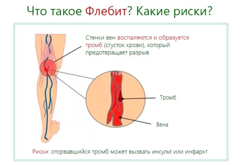 Катетер воспаление