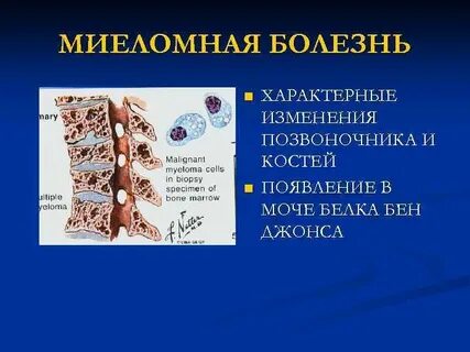 Миеломная болезнь мрт