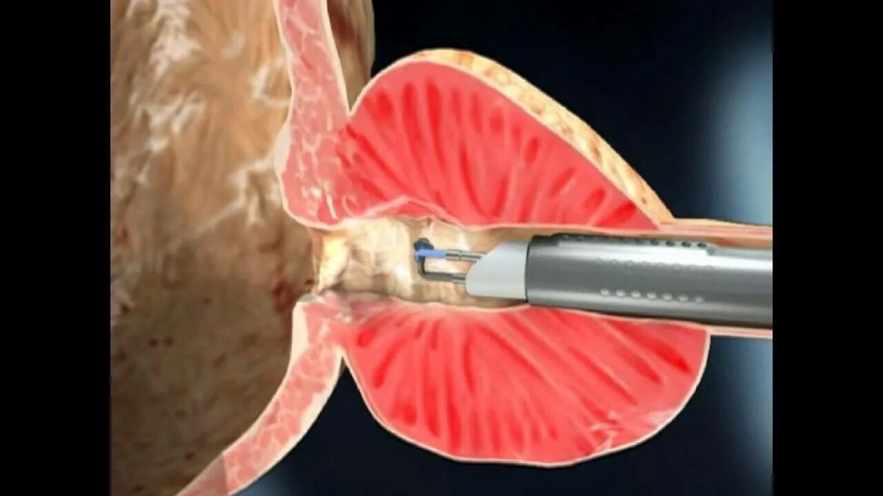 Предстательная железа операция лечение. Трансуретральная инцизия. Трансуретральная резекция. Трансуретральная инцизия простаты (ТУИП). Тур трансуретральная резекция простаты.