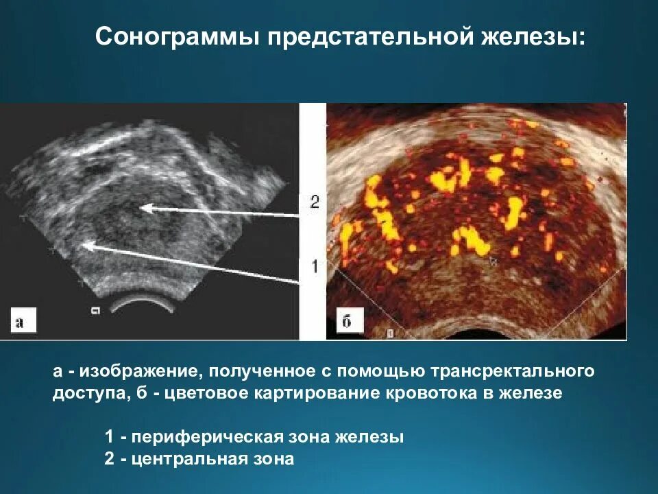 Дгпж узи. Трансректальное УЗИ предстательной железы. Ультразвуковая анатомия предстательной железы. УЗИ исследование предстательной железы.