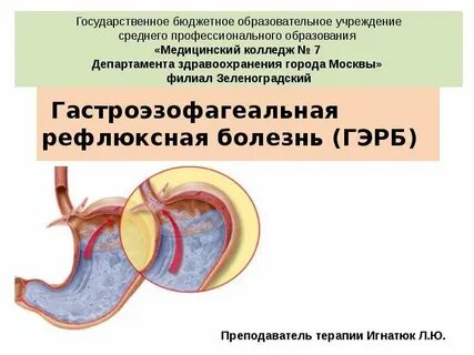Гастроэзофагеальная рефлюксная болезнь