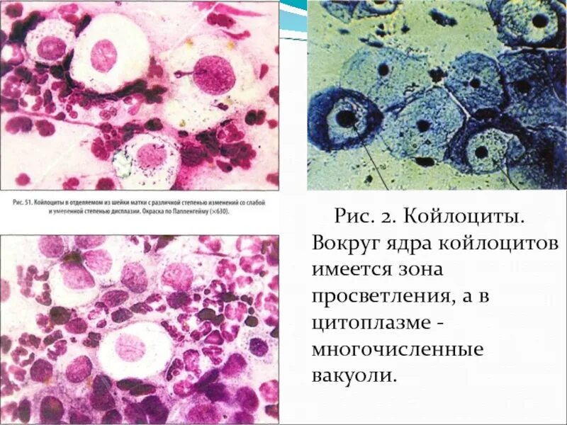 Дискариоз клеток шейки матки. Дисплазия шейки матки цитология. Дисплазия 11 эпителия шм. Плоскоклеточное интраэпителиальное поражение. Дисплазия по цитологии.
