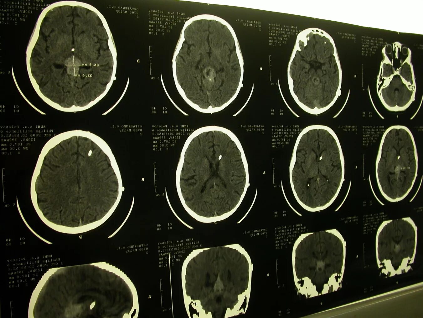 Диагноз кт с опухолью головного мозга. Доброкачественные опухоли головного мозга кт. Новообразование на кт головного мозга. Рентгеновская компьютерная томография головного мозга норма.