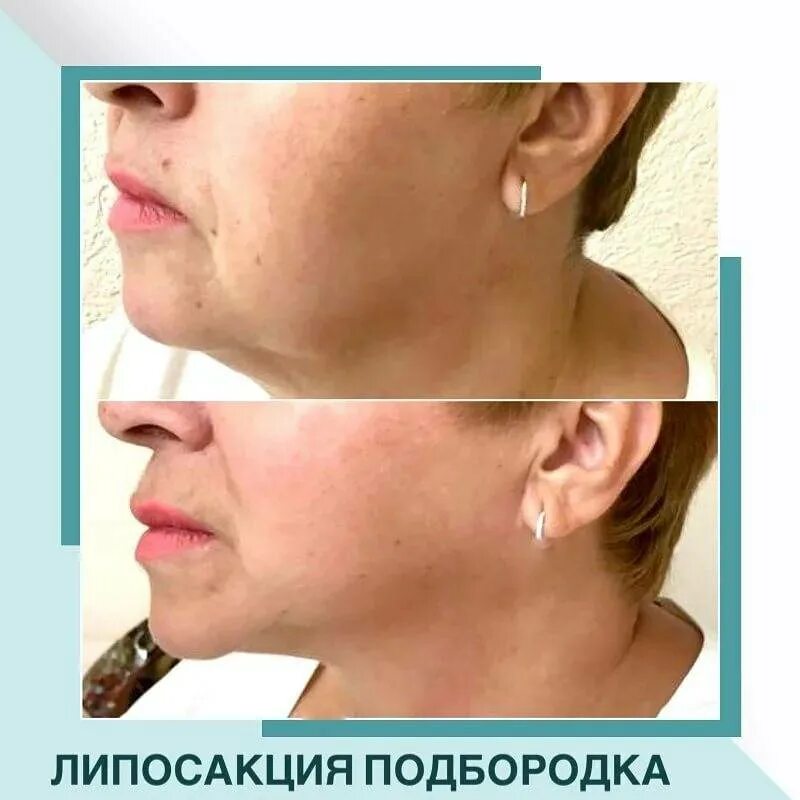 Лайт фит липолитик в нос. Процедура худое лицо отзывы фото до и после. Липолитики нижняя треть лица. Липолитики для лица лайт фит. Липолитики в лицо до и после.