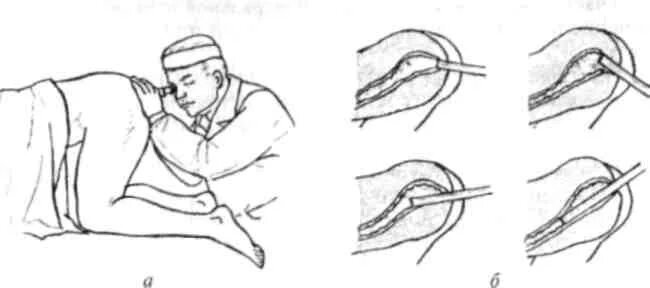 Колоноскопия алгоритм проведения манипуляции. Исследование прямой кишки ректоскопия. Исследование прямой кишки ректороманоскопия. Техника ректороманоскопия алгоритм. Как правильно вставить кишку