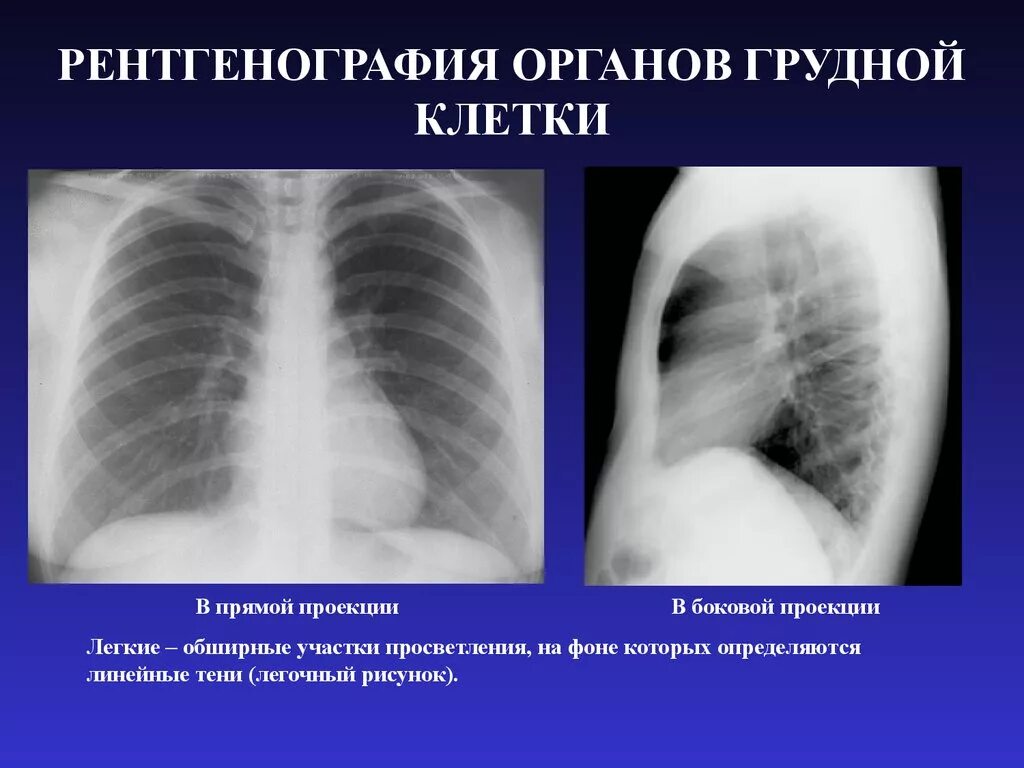 После флюорография можно можно кт делать. Рентген легкого норма. Гемоторакс рентген. Рентген лёгких в 2 проекциях. Флюорография.