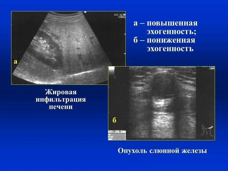 Поджелудочная диффузно повышенной эхогенности. Эхогенность повышенной печени. Сниженная эхогенность. Пониженная эхогенность. Пониженная эхогенность на УЗИ.