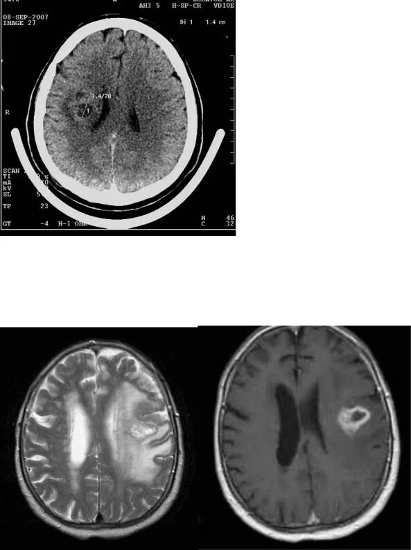 Лейкоэнцефалит