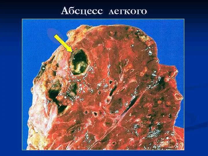 Гнойные абсцессы легких. Острый абсцесс легкого макропрепарат. Абсцесс легкого макропрепарат. Хронический абсцесс легкого макропрепарат. Абсцесс острый патанат.