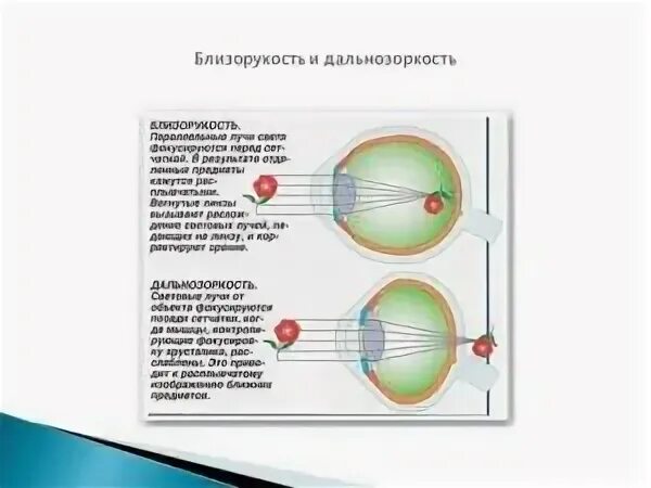 Близорукость переходящая в дальнозоркость