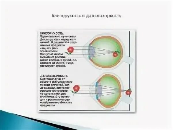 Миша страдает близорукостью а его брат дальнозоркостью. Норма близорукость дальнозоркость. Строение глаза при близорукости и дальнозоркости. Строение глаза гиперметропия. Строение глаза дальнозоркость.