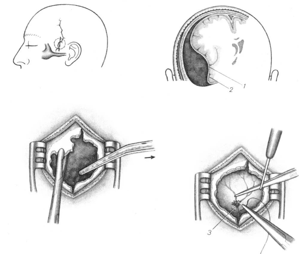 Декомпрессивная Трепанация. Трепанация черепа черепа гематома. Резекционная Трепанация черепа. Декомпрессивная Трепанация черепа. Гематома мозга операция