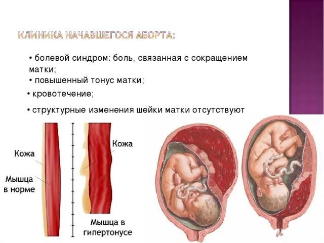 Тянет низ живота при беременности 39 недель. 19 Недель беременности гипертонус матки. Гипертонус живота при беременности. Беременности тонус в матке при беременности.