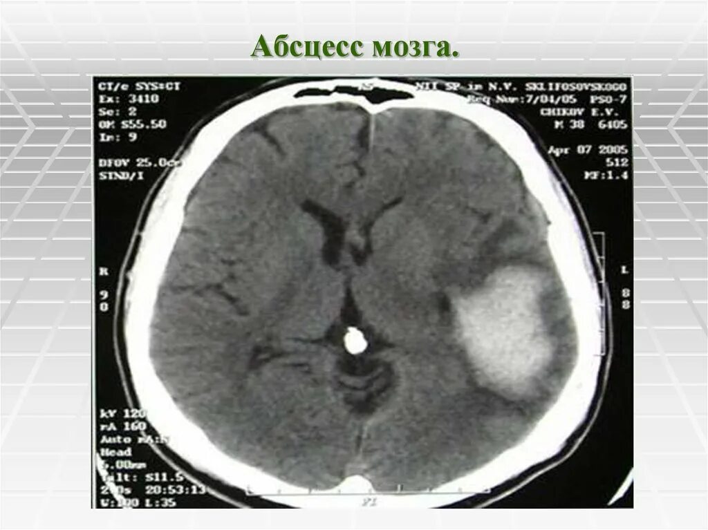 Абсцесс мозга. Отогенные абсцессы головного мозга. Отогенный абсцесс головного мозга. Кт при абсцессе головного мозга. Абсцесс головного мозга кт.