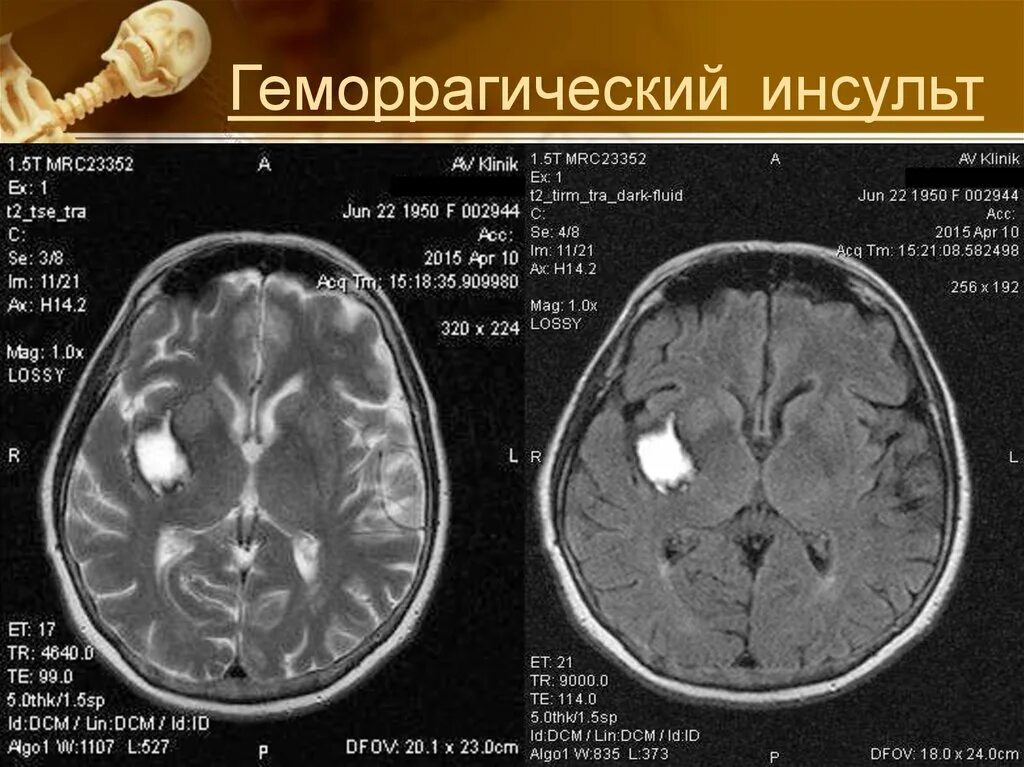 Геморрагический инсульт. Ґоморрогический инсульт. Геморрагический нсуль. Геморрагический инсул т. Был геморрагический инсульт