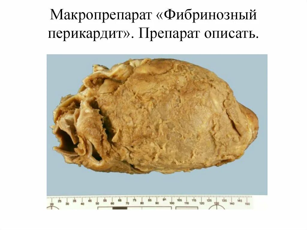 Воспаление - презентация онлайн
