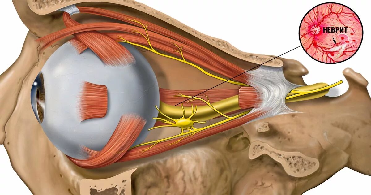 Почему воспаляется нерв. Неврит зрительного нерва. Тройничный нерв и зрительный нерв. Неврит глазодвигательного нерва. Ретробульбарный неврит зрительного нерва.