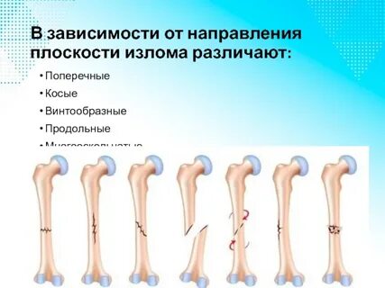 Переломы поперечные косые