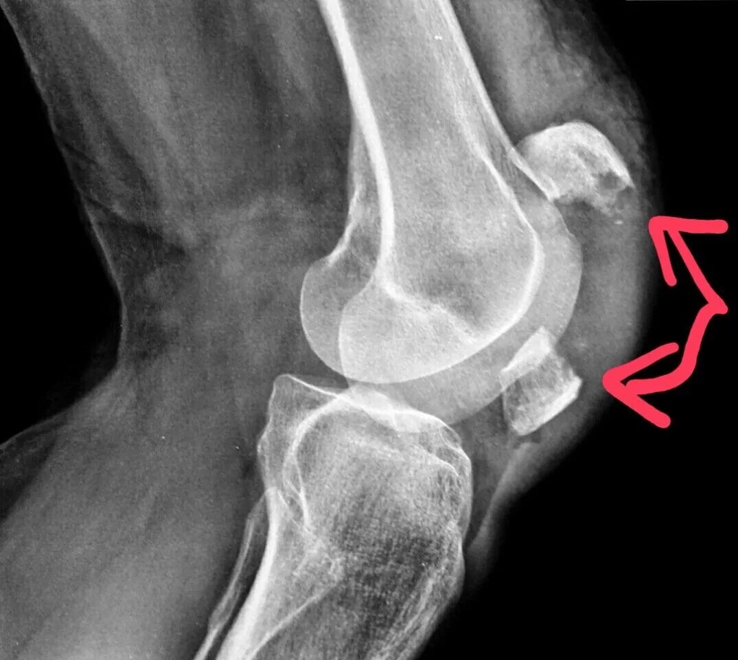 Перелом надколенника рентген. Перелом чашечки коленного сустава рентген. Перелом коленного сустава рентген. Рентген колена перелом надколенника.