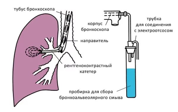 Бронхопульмональный лаваж. Схема проведения диагностического бронхоальвеолярного лаважа. Лаваж дыхательных путей. Лаваж бронхиального дерева.