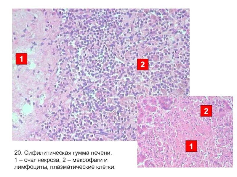 Печень микропрепарат описание. Гумма печени микропрепарат исход. Сифилитическая Гумма печени микропрепарат. Солитарная Гумма печени микропрепарат. Сифилис печени микропрепарат.