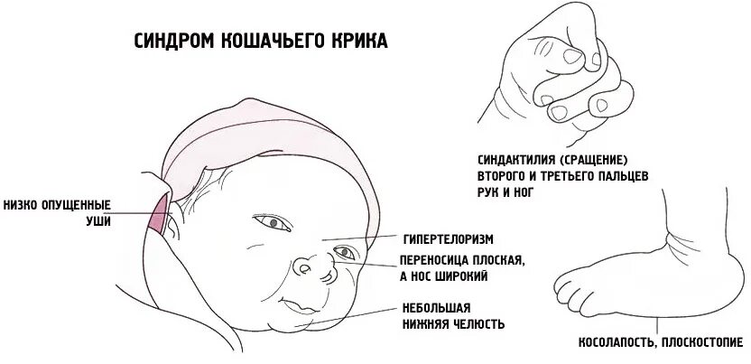 Что такое синдром крика. Лежена синдром клинические признаки. клинические симптомы кошачьего крика. синдром кошачьего крика фенотипические признаки. синдром кошачьего крика проявление.