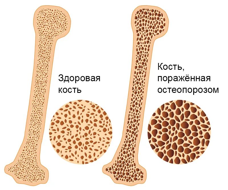 Пористая кость. Деминерализация костной ткани. Ремоделирование костной ткани. Болезнь костей остеопороз. Минерализация костной ткани биохимия.
