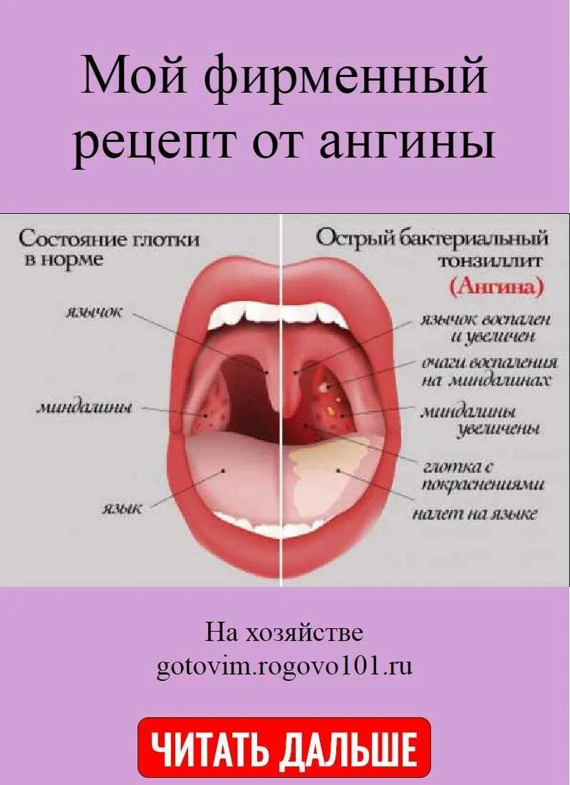 Как лечить ангину с температурой у ребенка