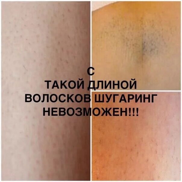 Схемы нанесения пасты для шугаринга. Нанесение шугаринга. Эпиляция зоны глубокого бикини. Волосы 4 мм для шугаринга. Депиляция сколько см.