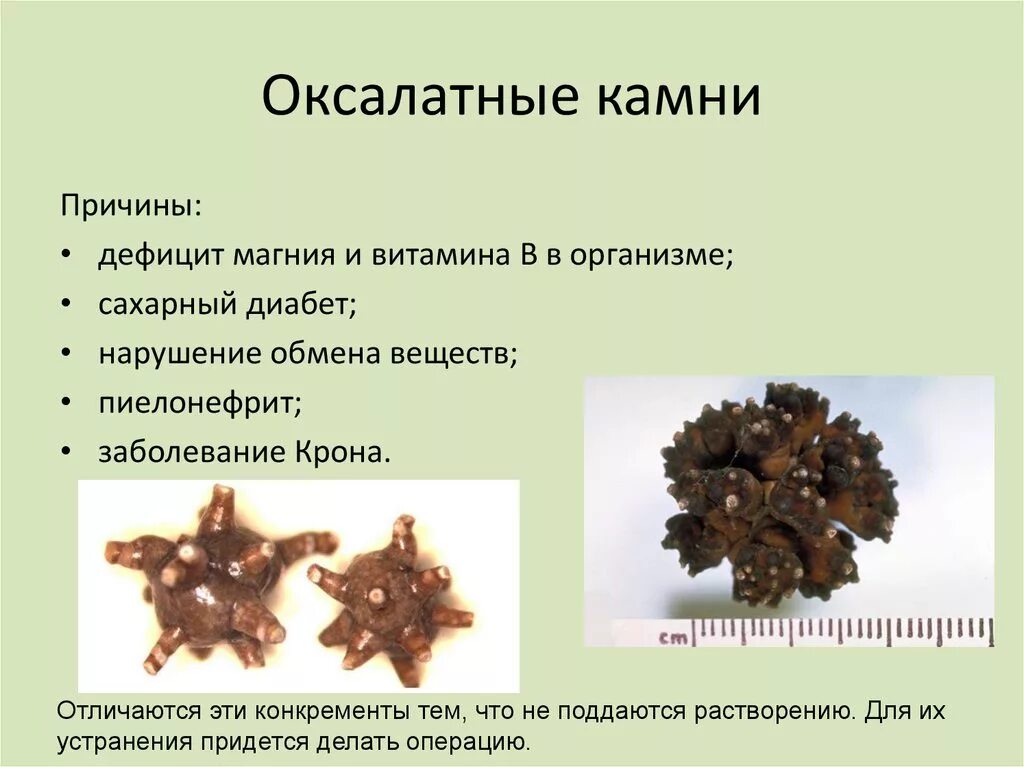 Растворение оксалатных камней. Оксалатные камни в почках причины. Оксалаты кальция камни в почках. Оксалатные камни состав. Уратные оксалатные камни в почках.