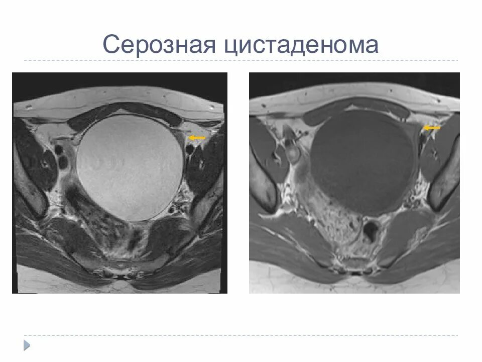 Папиллярная серозная цистаденома. Цистаденома яичника на УЗИ. Папиллярная цистаденома гистология. Цистаденома яичников на мрт. Серозная пограничная опухоль