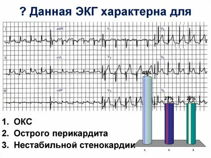 Стенокардия на экг
