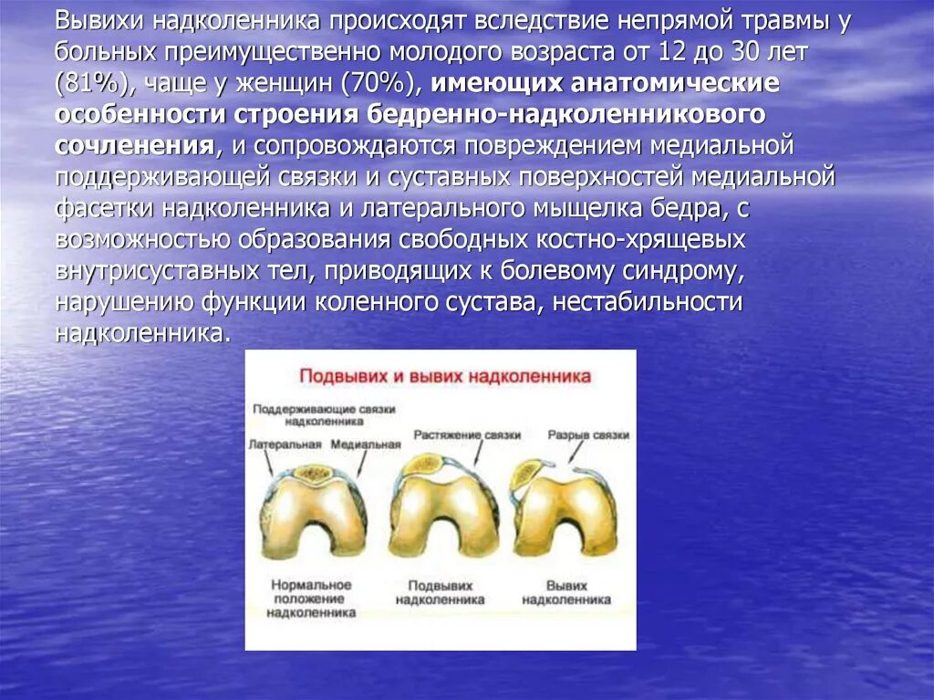 Латерализация надколенника. Вывих подвывих надколенника. Боковой вывих надколенника. Латеральная дислокация надколенника. Латеральный подвывих надколенника.