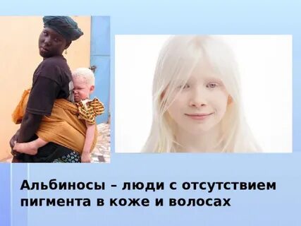 Отсутствие пигмента меланина