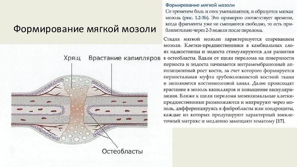 Формирование мозоли при переломе. Стадии образования костной мозоли. слои костной мозоли. мягкие ткани в травматологии ао.