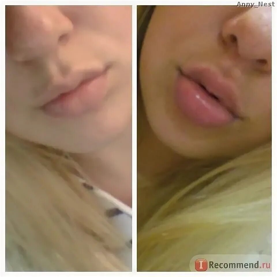 Увеличение губ гиалуроновой кислотой сколько держится. Филлеры в губы до и после 1мл. Гиалуронка губы тюмень. Коррекция губ гиалуроновой кислотой 1 мл. Увеличение губ кемерово.