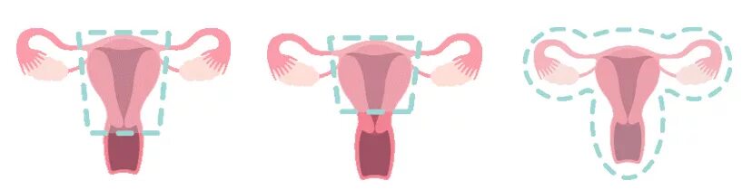 Тотальная гистерэктомия. Тотальная и субтотальная гистерэктомия. субтотальная гистерэктомия техника. эндоскопическая тотальная гистерэктомия.