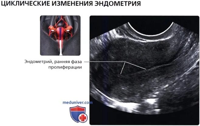 Тонкий слой эндометрия. Эндометрий базальный и функциональный слой. Тонкий слой эндометрия. Узи картина полипа эндометрия. Эндометрий для беременности.