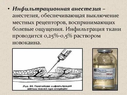 Что такое местная анестезия
