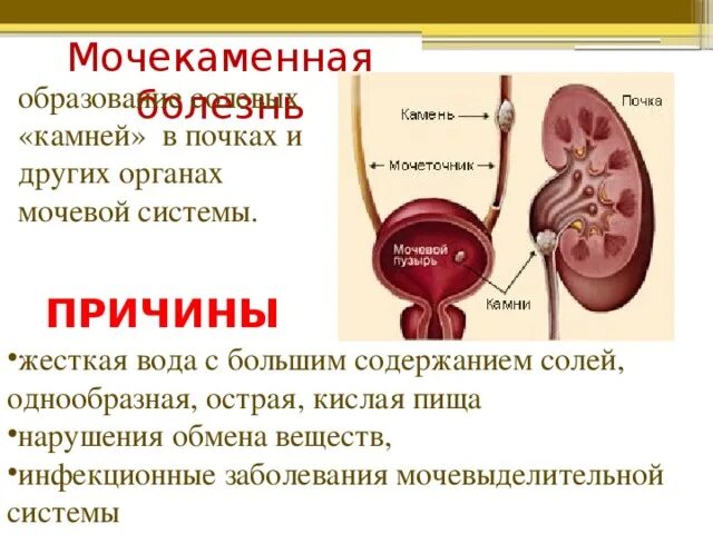 Заболевания мочевыделительной системы мочекаменная болезнь. Причины мочекаменной болезни у людей биология 8 класс. Мочекаменная болезнь симптомы биология 8 класс. Заболевание почек мочекаменная болезнь симптомы.