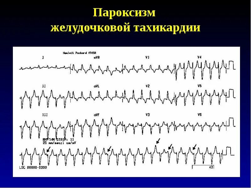 Пароксизм желудочковой тахикардии. Пароксизмальная желудочковая тахикардия. Пароксизмальная желудочковая тахикардия классификация. Аритмии желудочковые блокады.