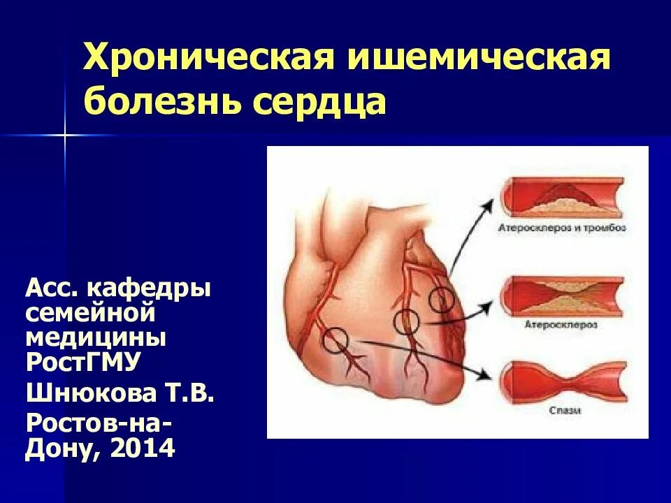 Ишемичкскаяболезнь сердца. Хроническая болезнь сердца. Хроническая ишемическая болезнь. Ишемическая болезнь сердца это хроническое заболевание.