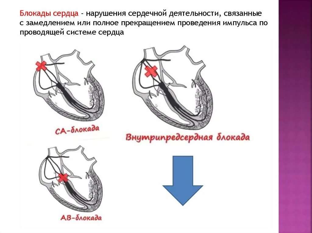 Блокада сердца это опасно. Блокада сердца. Проводящая система сердца. Блокада проводящей системы. Блокада проведения импульсов в сердце.