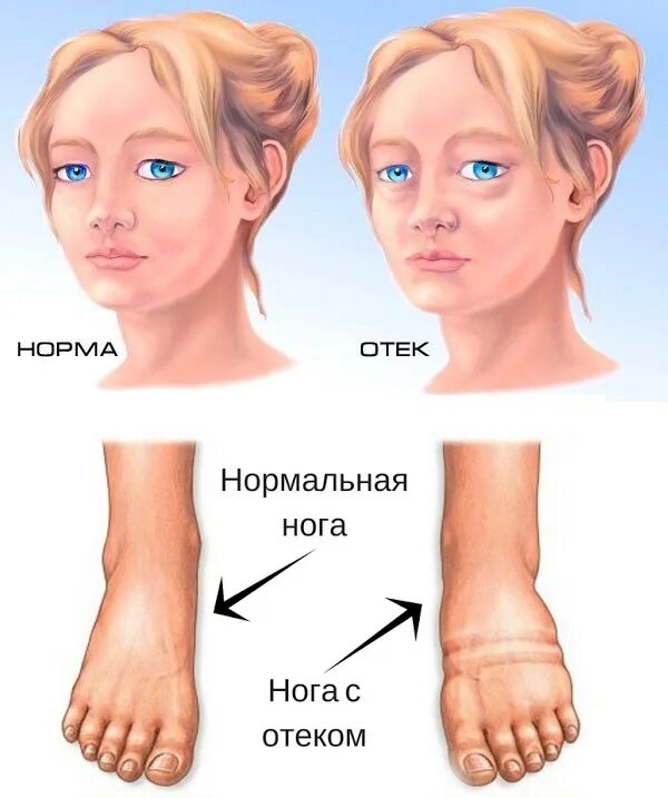 Почему лицо одутловатое