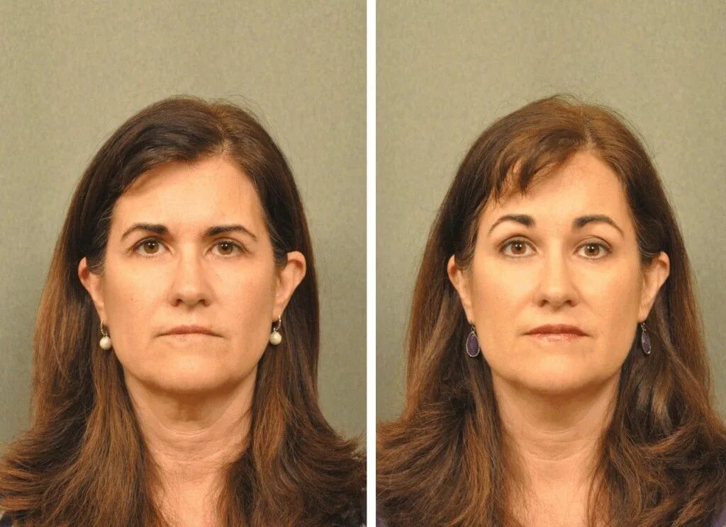 Brow лифтинг. Brow lift операция. Транспальпебральный броулифт. Броулифтинг. Броулифт.