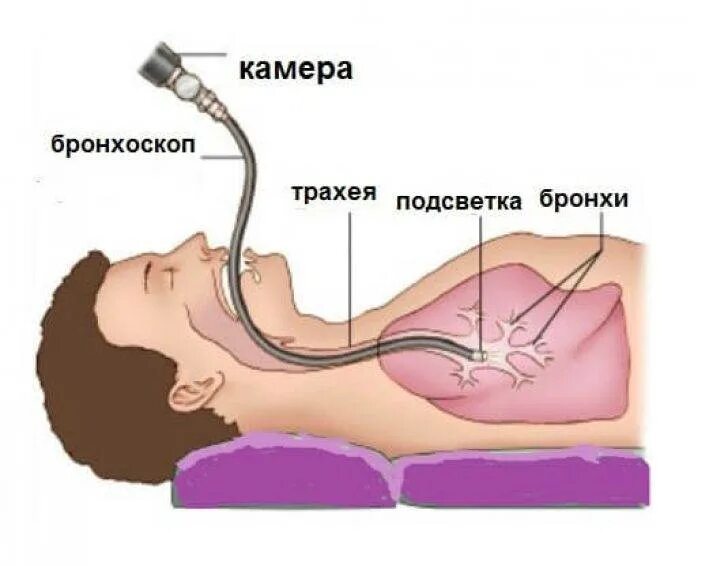 Бронхоскопию делают под наркозом