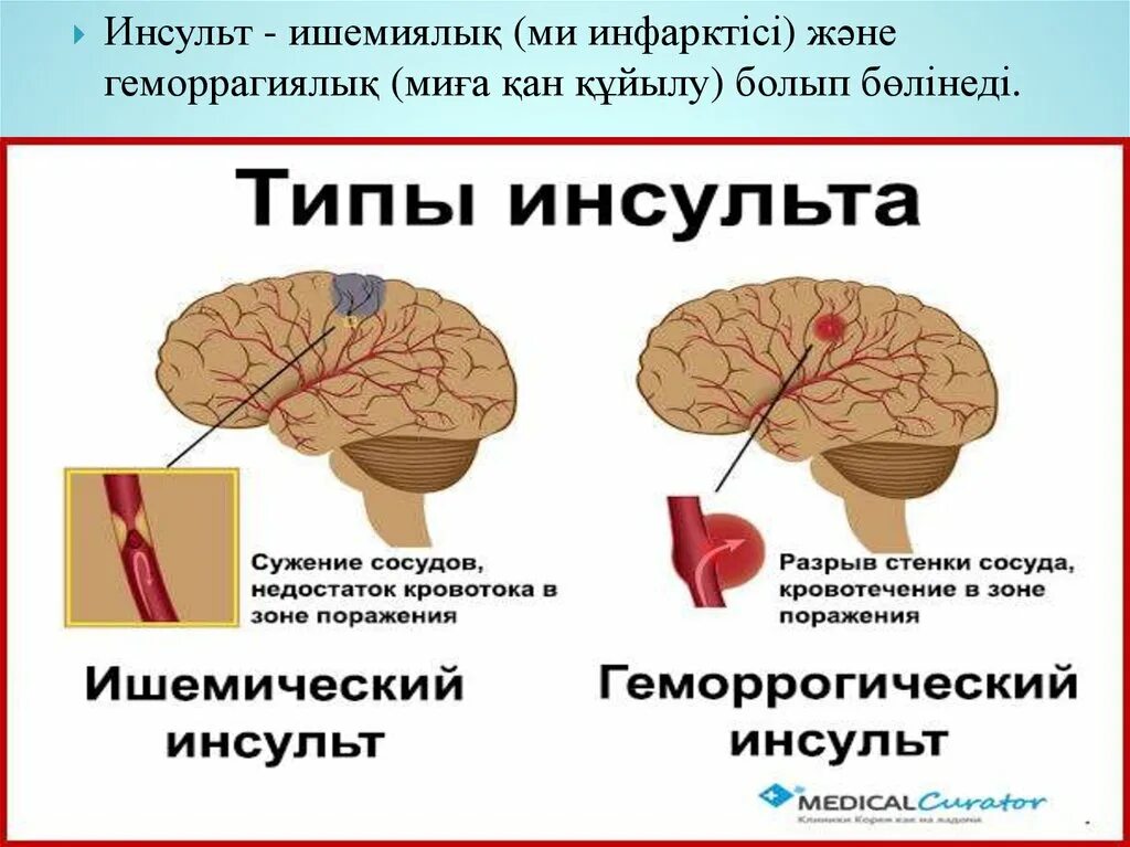 Зона инсульта. Инсульт. Картинки на тему инсульт.