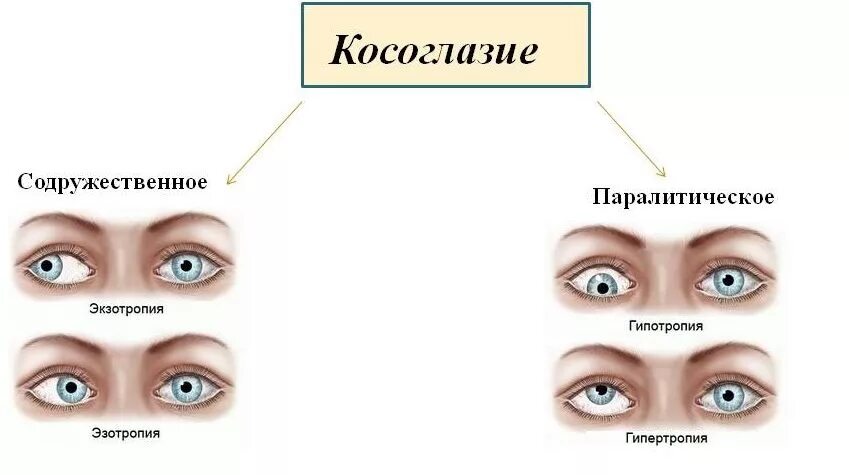 первичное косоглазие. косоглазие развивается при поражении. паретическое косоглазие. первичное косоглазие. первичное косоглазие.