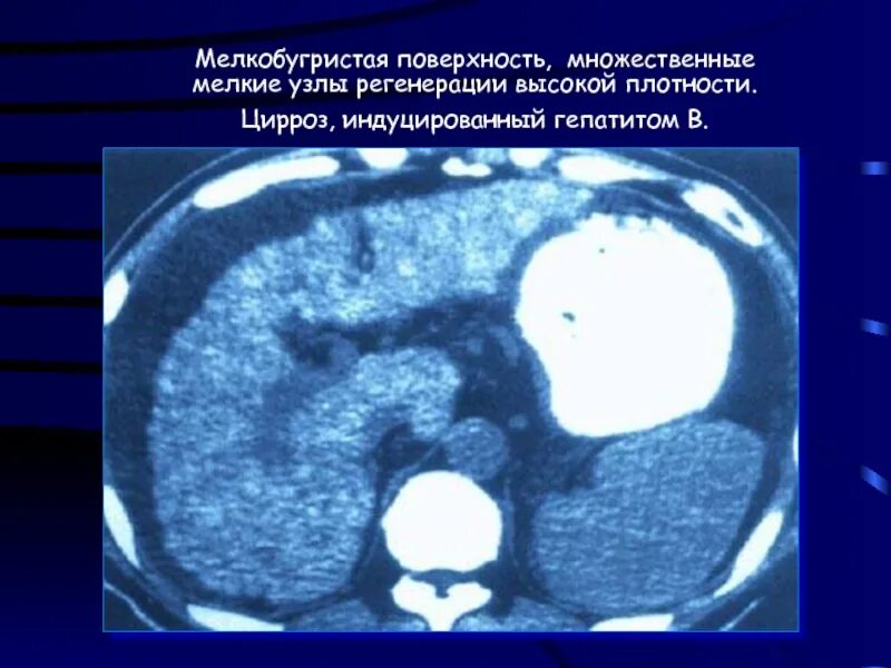 Очаги регенерации. Узлы регенерации печени. узлы регенерации печени при циррозе. множественное узел печени. мелкобугристая поверхность печени.