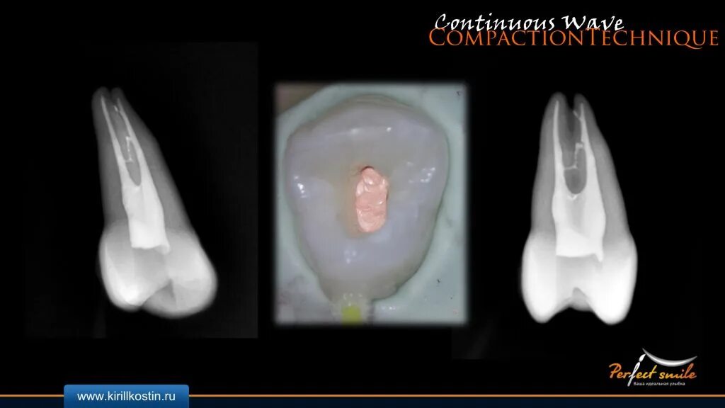 Гуттаперча для пломбирования корневых каналов. Пломбировка корневого канала гуттаперчей. Метод вертикальной конденсации для пломбирования корневых каналов. Рентген контроль обтурации корневых каналов. Пломбировка корневых каналов